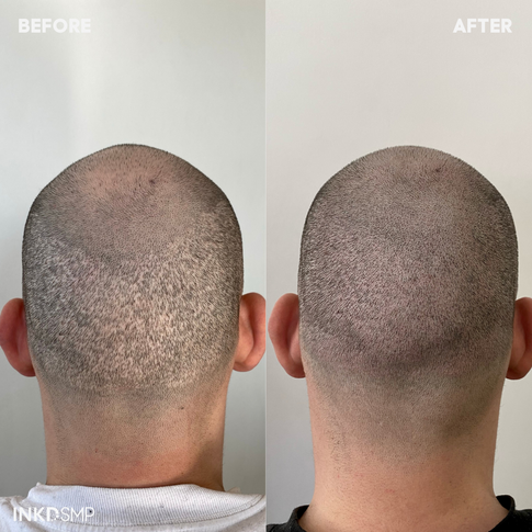 Hair transplant scars