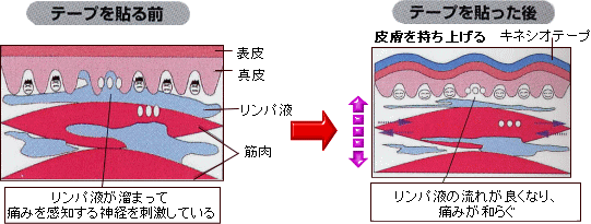 キネシオテーピング説明