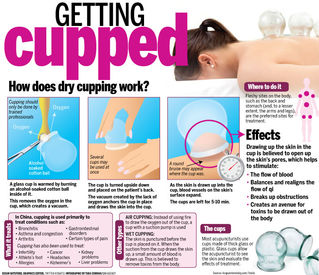 Cupping Therapy Safe or Not? 拔罐小知识