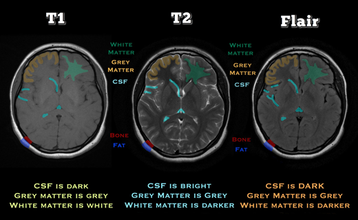 The distinct sub regions of tumor predicted using MR imaging are as follow: • “Enhancing tumor” –the area of hyper intensity in T1Gd relative to T1 sequence • “Non-enhancing tumor” (NET) • “Necrotic tumor” –two different histological entities, but exhibits very similar imaging characteristics • “Peritumoral edema” that is hyper intense in FLAIR sequence