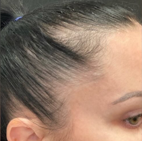 Hair Restoration