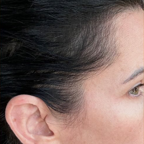 Hair Restoration