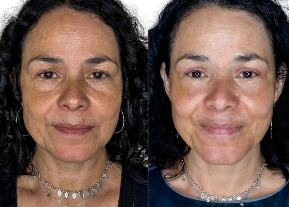 Front view before and after of woman showing enhanced skin tone, reduced pigmentation, and facial rejuvenation from single fibroblast treatmen