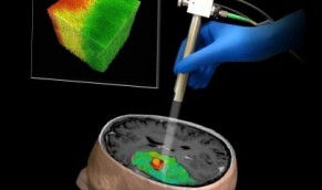 La tomographie par cohérence optique pour mieux enlever les tumeurs du cerveau