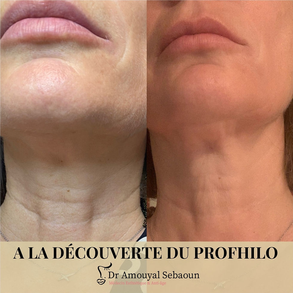 A la découverte du Profhilo