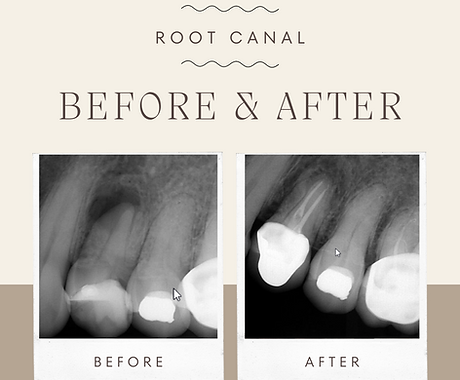 root canal before and after