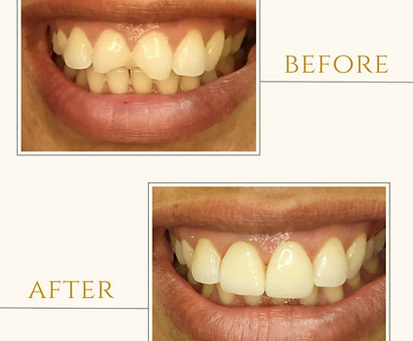 Minimal prepping case before and after