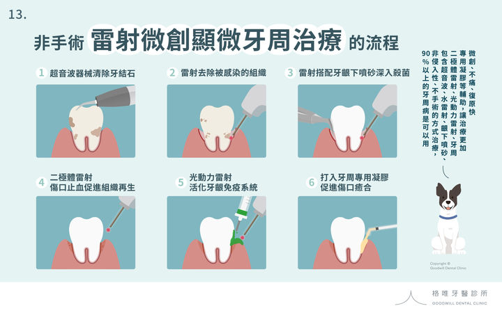 13.非手術雷射微創牙周治療的流程.jpg
