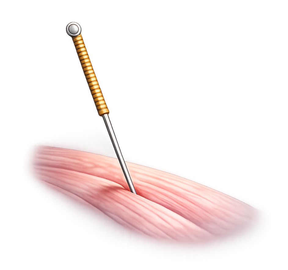 Dry Needling