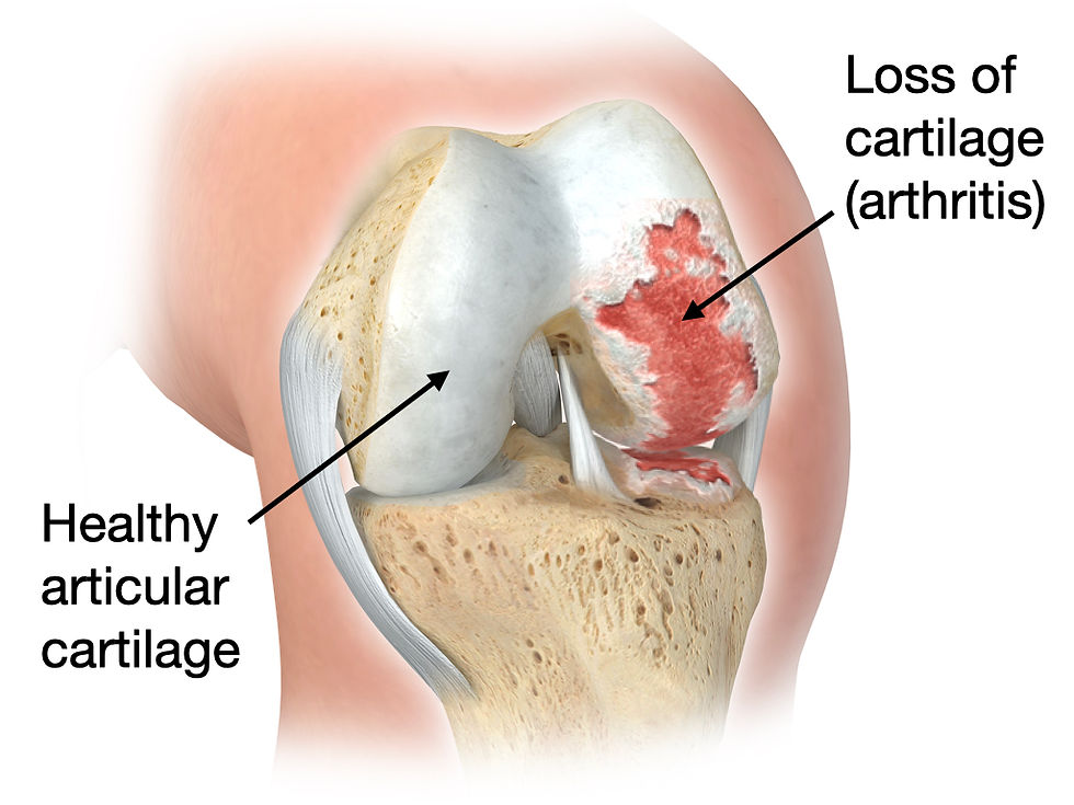 Arthritis images.003.jpeg
