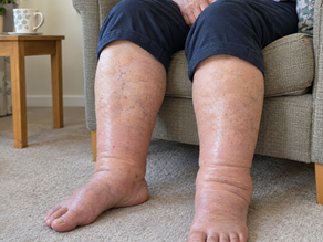 Lower-limb oedema explained: why legs swell, what helps, and when to worry