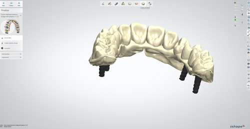 CAD/CAM course from 3 Shape Designer (Implant Related Crown Course ...