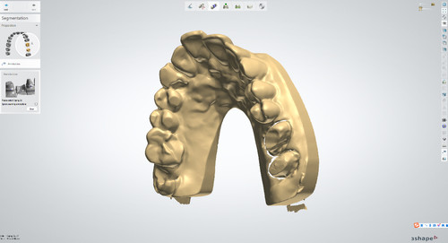 CAD/CAM course from 3 Shape Designer (coping course) | monde-dental-lab