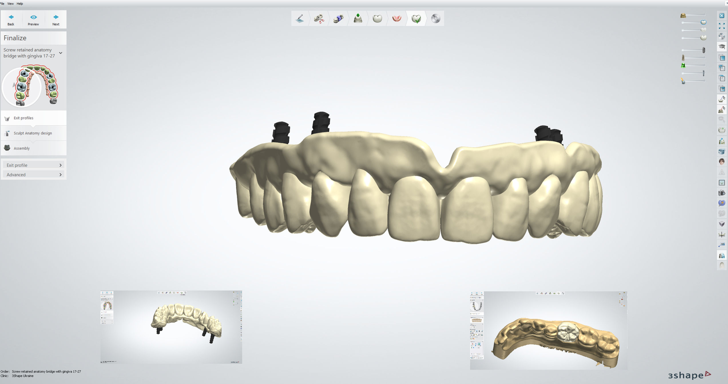 Implant related Crown Course