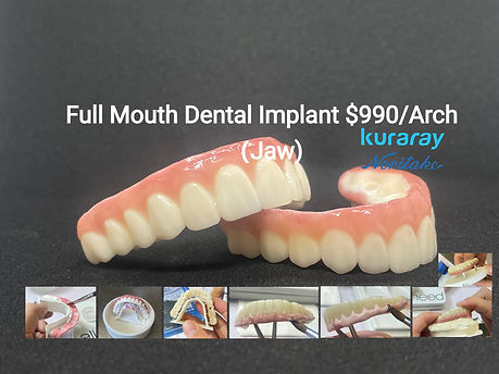 full house implant arch