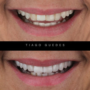 Caso de aplicação de lentes de contato dental antes e depois em Fibonacci Odontologia