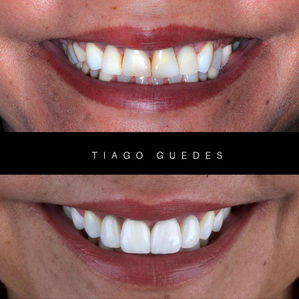 Caso de aplicação de lentes de contato dental antes e depois em Fibonacci Odontologia