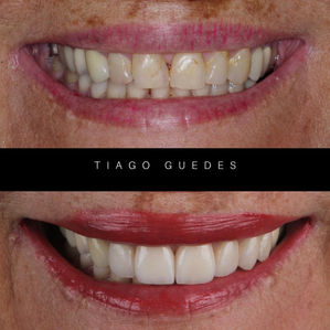 Caso de aplicação de lentes de contato dental antes e depois em Fibonacci Odontologia