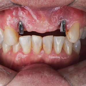 detalhe após implantar pino de titânio em fibonacci odontologia