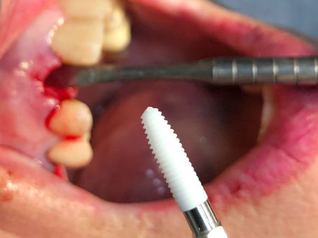 Implantes de Cerâmica, benefícios para sua Saúde