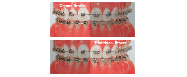 Damon Braces VS Traditional Braces 