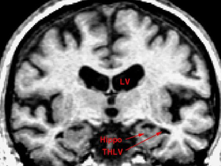 Gum infection linked to Alzheimer's disease, new study suggests