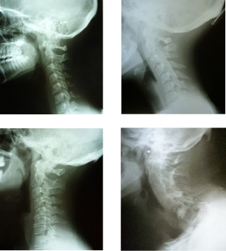 Study of neck degeneration