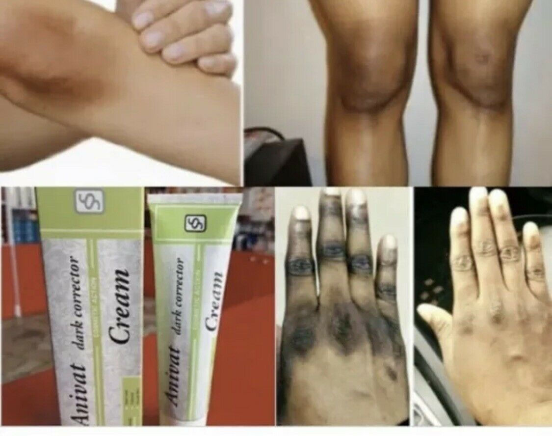 ANIVAT DARK CORRECTOR CREAM SPOTS DARK KNUCKLES KNEES ELBOW ETC 50ML ORIGINAL