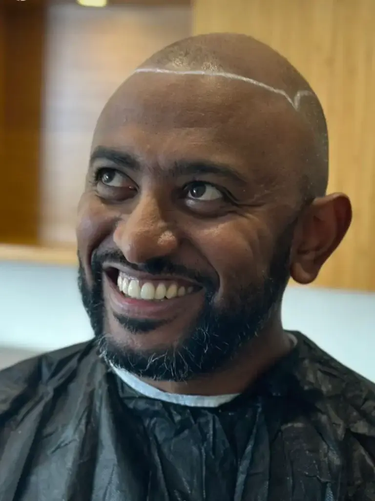 Afro Hair Transplant Hairline design