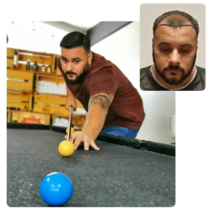 Hair Transplant Before After Turkey
