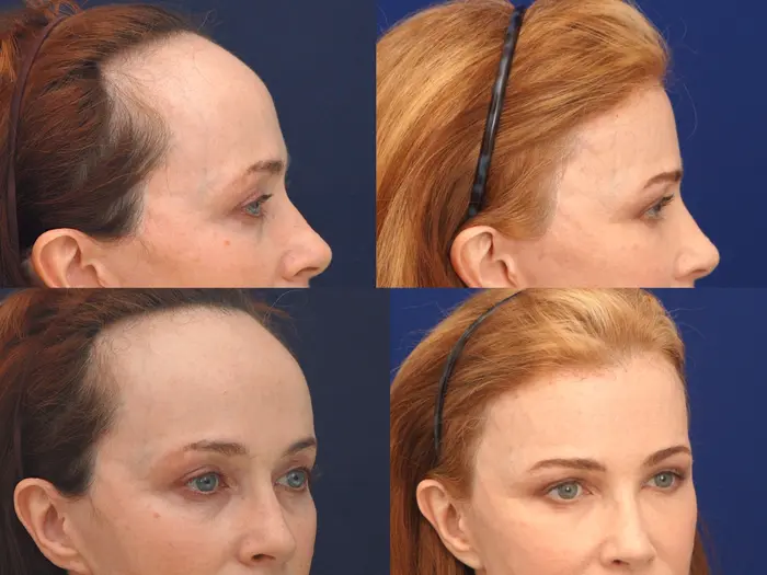 Forehead Reduction Hair Transplant