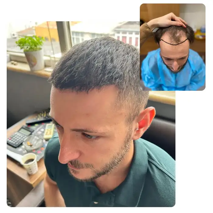 Hair Transplant Before After Turkey