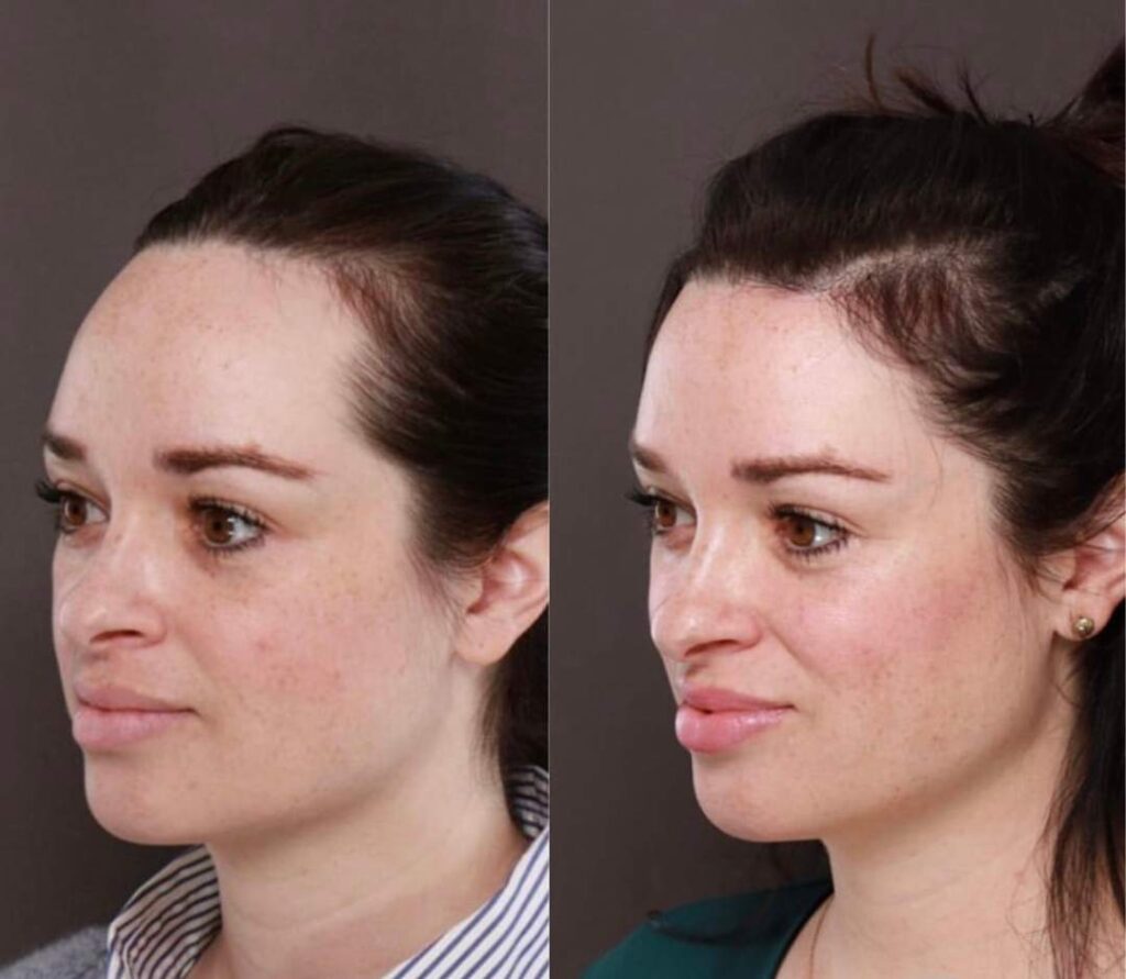 Forehead reduction surgery before and after
