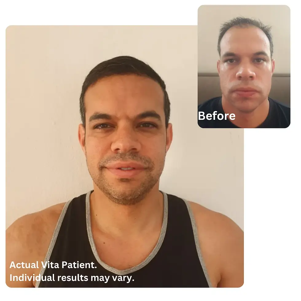 Ali before after hair transplant in Turkey with Vita Hair Clinic