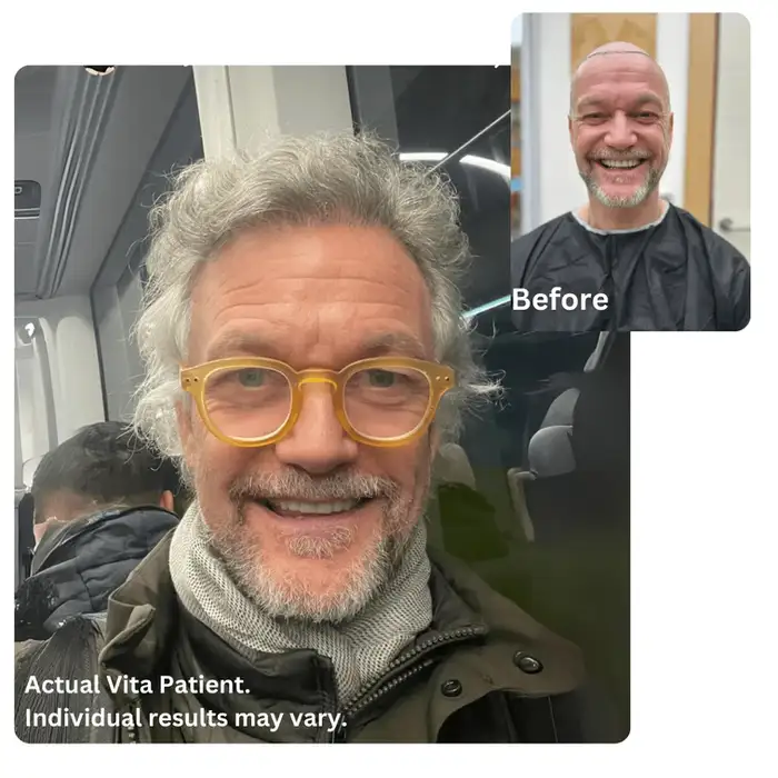 Hair Transplant Before After Turkey