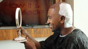 After Afro Hair Transplant in Turkey