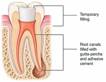 Root canal filling.png
