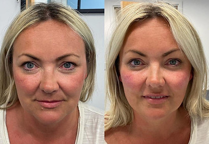 A lady with a treatment result for cheek fillers and dermal fillers