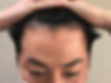 M字額成因