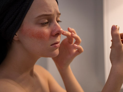 Person with visible facial redness on the cheeks and nose examining their skin closely in a mirror.