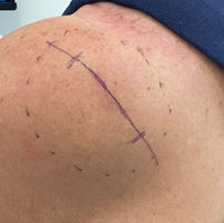 Lipoma of the shoulder