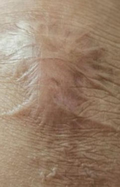 Before Knee Keloid.jpg