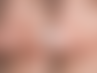 Avant après extraction des points noirs sur le nez après un nettoyage de peau en profondeur avec soin purifiant intense en institut.