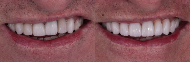 Managing Esthetic Discrepancies