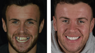 The Patient Asked for Veneers. The Diagnosis Said Something Else.