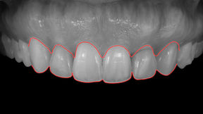 Achieving Balance in a Smile with a Canted Maxilla