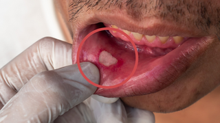 Mouth Ulcers in General Practice: Assessment, Triggers, and Red Flags