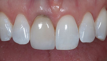 Managing Dark Tooth Challenges with Minimal Preparation.jpeg