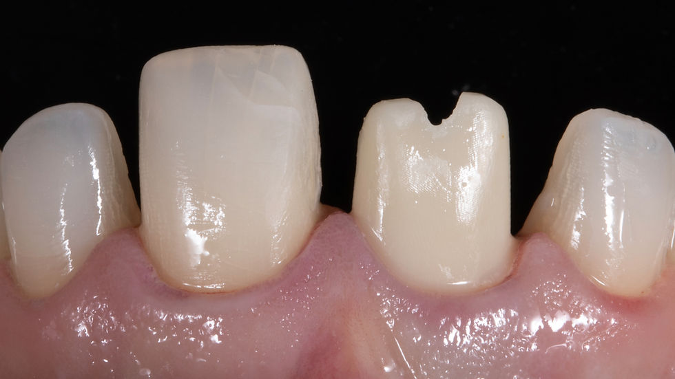 Implant Restoration Alongside a Veneer: Planning the “Magic Four”