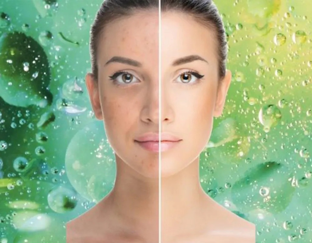 Woman's face before and after skin peel